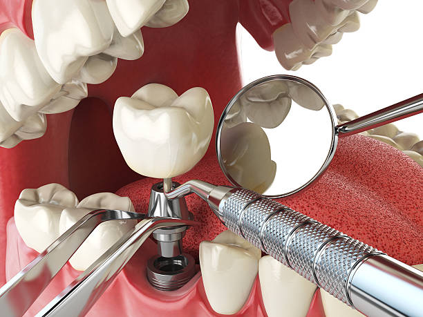Best Emergency Denture Repair in Scotchtown, NY